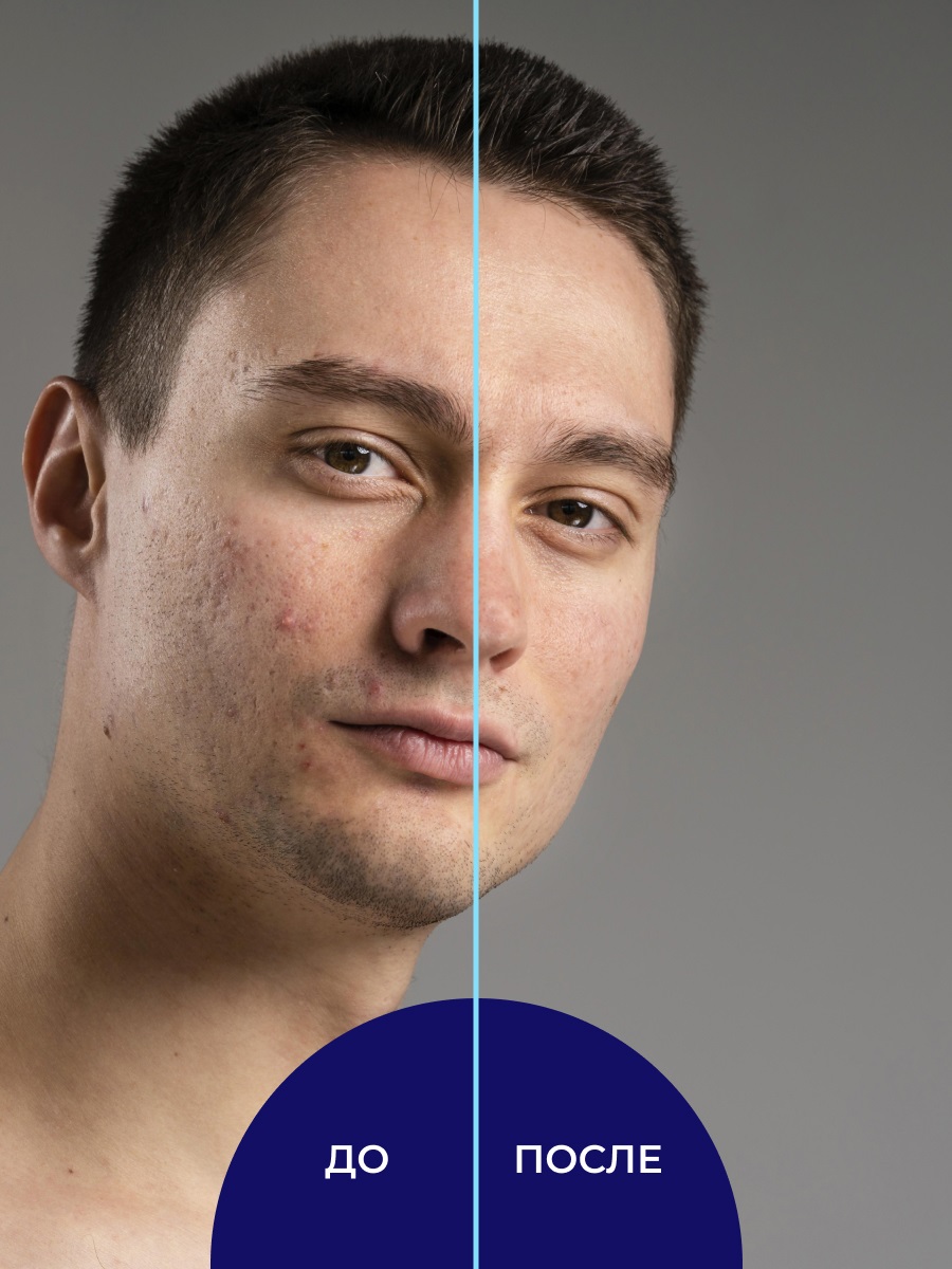 Сиберина Тоник для лица и спины против прыщей, угрей и чёрных точек с цинком, 50 мл (Siberina, Тонизирование) Сиберина Тоник для лица и спины против прыщей, угрей и чёрных точек с цинком, 50 мл (Siberina, Тонизирование) фото 3