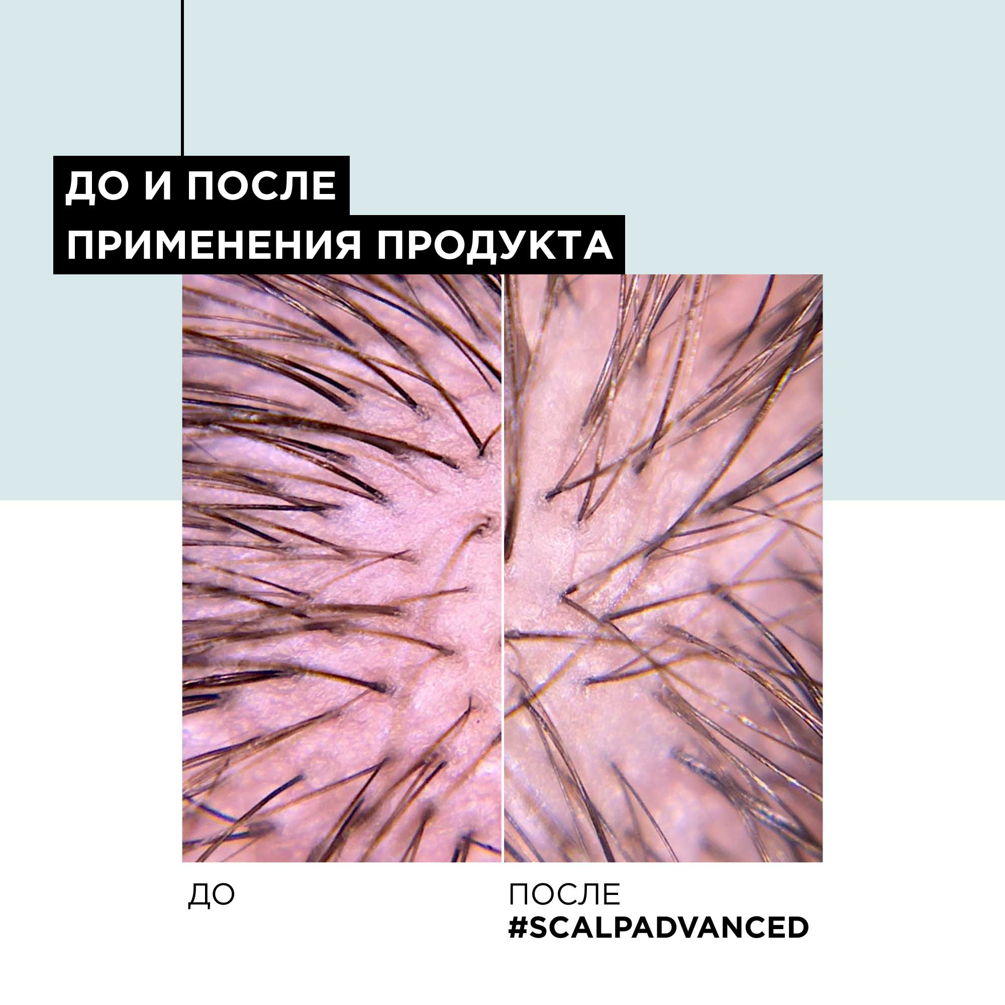 Лореаль Профессионель Зимний набор Scalp Advanced для чувствительной кожи головы: шампунь 300 мл + смываемый уход 200 мл (L'oreal Professionnel, Serie Expert) фото 10