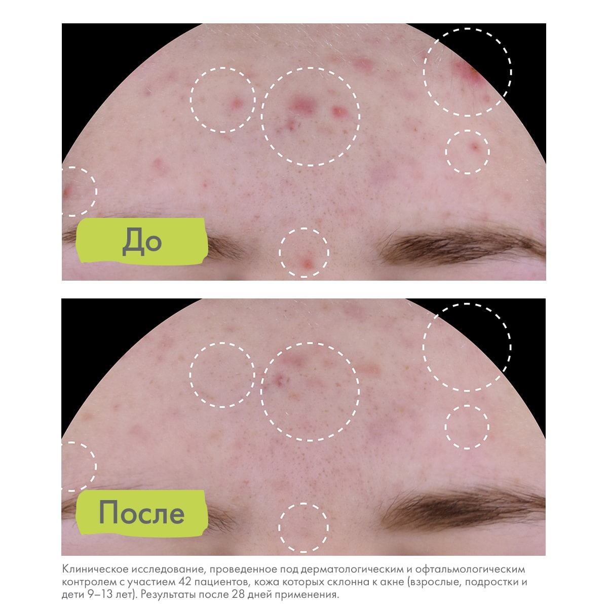 Адерма Флюид против дефектов кожи, склонной к акне AC Perfect, 40 мл (A-Derma, Biology) фото 6