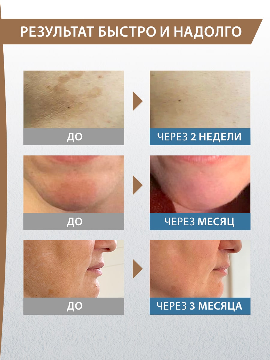 Дюкрэ Концентрат против пигментации 18+, 30 мл (Ducray, Melascreen) фото 4