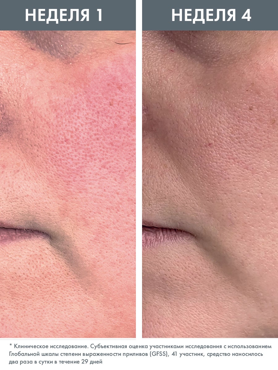 Авен Концентрат для кожи, склонной к покраснениям Rosamed, 30 мл (Avene, Antirougeurs) фото 5