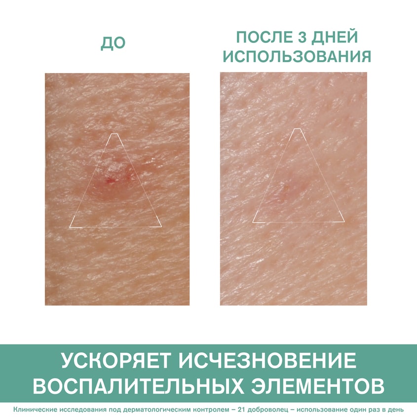 Урьяж Паста SOS-уход, 15 г (Uriage, Hyseac) Урьяж Паста SOS-уход, 15 г (Uriage, Hyseac) фото 2