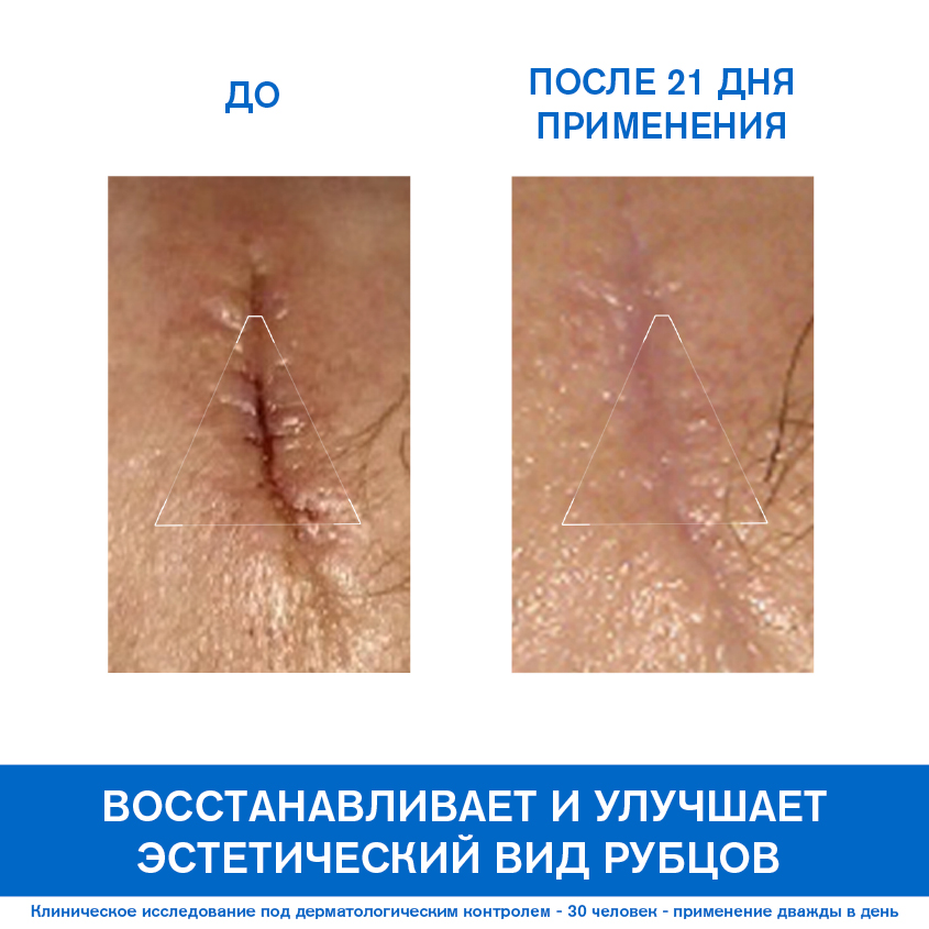 Урьяж Цика-крем с медью и цинком SPF50+, 40 мл (Uriage, Bariederm) фото 2